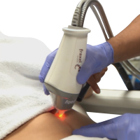 laser removal
